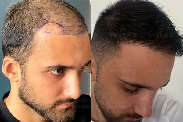 Worbimed | Hair Transplant Turkey Istanbul | Eyebrow Transplant | Beard Transplant - Saç Transplantasyonu Kliniği - İstanbul Bahçelievler