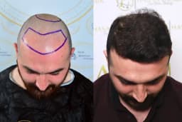 HASAN DEMİR SAÇ EKİMİ ANKARA