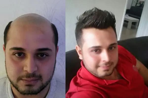 Gaziantep Protez Saç - Güzellik Salonu - Gaziantep Şahinbey