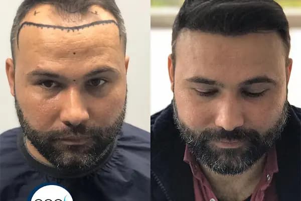 Aydın Saç Ekim Merkezi Eges Hair Transplant Clinic - Saç Transplantasyonu Kliniği - Aydın Karpuzlu