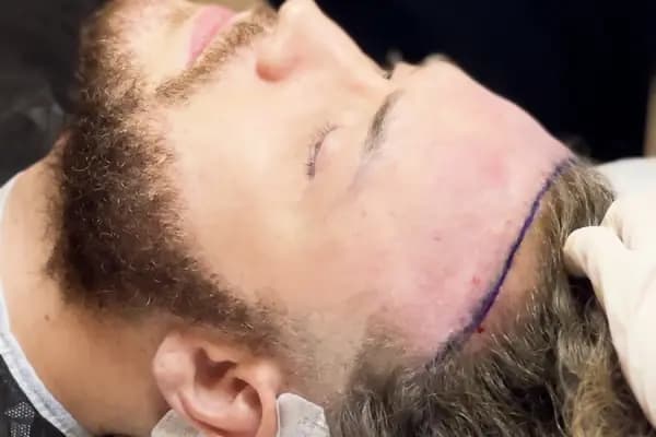 Implant World Hair -BEST HAIR TRANSPLANT CLINIC TURKEY - Saç Transplantasyonu Kliniği - İstanbul Üsküdar