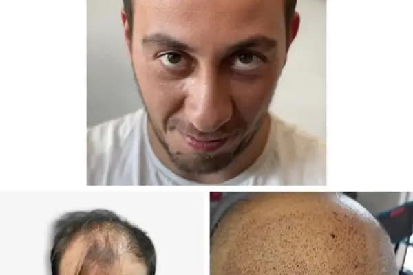 Saç Ekim Merkezi - Saç Transplantasyonu Kliniği - Ankara Çankaya