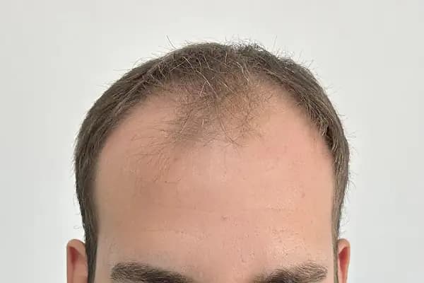 İbrahim Erayhan-Saç Ekimi-Bursa Tıp Merkezi - Hairtransplant Clinic - Saç Transplantasyonu Kliniği - Bursa Gemlik
