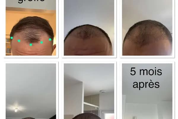 BELLA HAIR - Greffe de Cheveux- DHI-FUE - Saç Transplantasyonu Kliniği - İstanbul Arnavutköy
