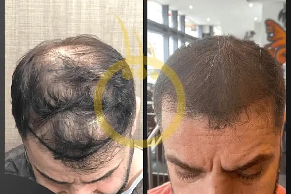 One Hair Clinic Transplantation - Plastic Esthetic - Saç Yenileme Hizmeti - İstanbul Ataşehir