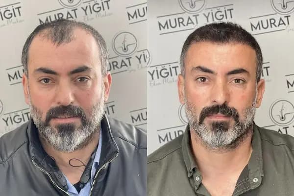 Gaziantep Saç Ekimi - Murat Yiğit - Sağlık ve Güzellik Merkezi - Gaziantep Nizip