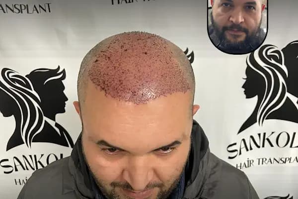 Sankolis İstanbul Hair Transplant - Saç Ekimi İstanbul - Saç Transplantasyonu Kliniği - İstanbul Kartal