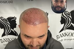 Sankolis İstanbul Hair Transplant - Saç Ekimi İstanbul