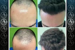 Mediavrupa Saç Ekim | Hair Transplant Turkey Istanbul | Saç Ekim Merkezi İstanbul | FUE Saç Ekimi | DHİ Saç Ekimi |
