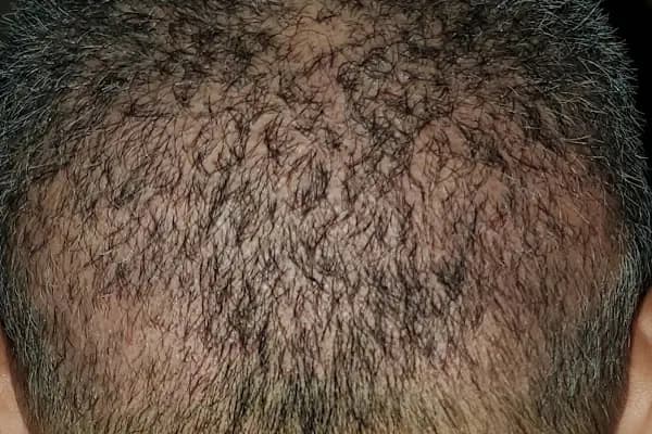 Serkan Aydin Hair Transplant - Saç Transplantasyonu Kliniği - İstanbul Üsküdar