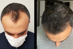 Клиника по пересадке волос Анталья VIVAEST - Saç Ekimi - Hair Transplant Antalya