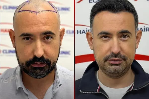 Balıkesir Saç Ekim Merkezi - Saç Yenileme Hizmeti - Balıkesir Karesi