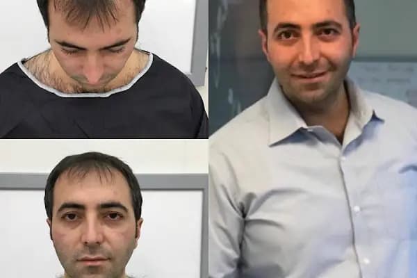 Capillum Clinic Saç Ekimi ve Saç Sağlığı Merkezi - Saç Transplantasyonu Kliniği - İstanbul Ataşehir