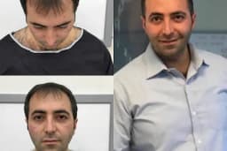 Capillum Clinic Saç Ekimi ve Saç Sağlığı Merkezi