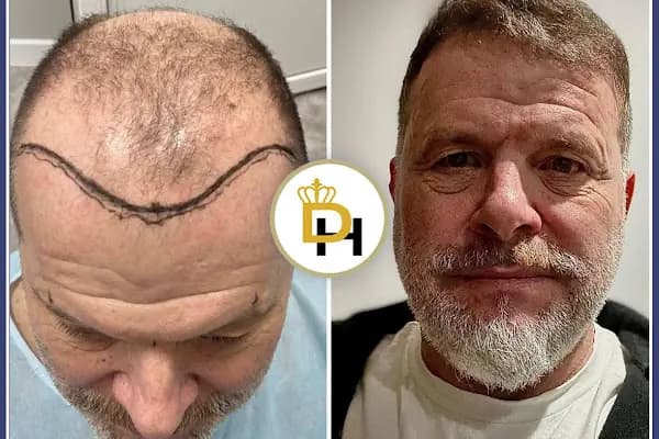 Gaziantep Fue Saç Ekim - Docshair Arif UĞUR - Saç Yenileme Hizmeti - Gaziantep Nizip