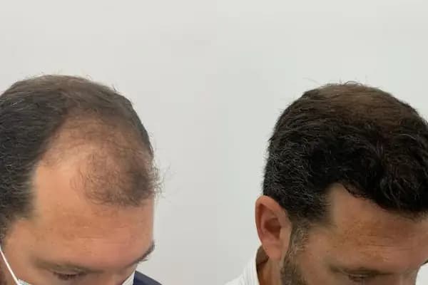 Allina Hair Clinic / Saç Ekimi ve Saç Sorunları Merkezi - Saç Transplantasyonu Kliniği - İstanbul Bakırköy