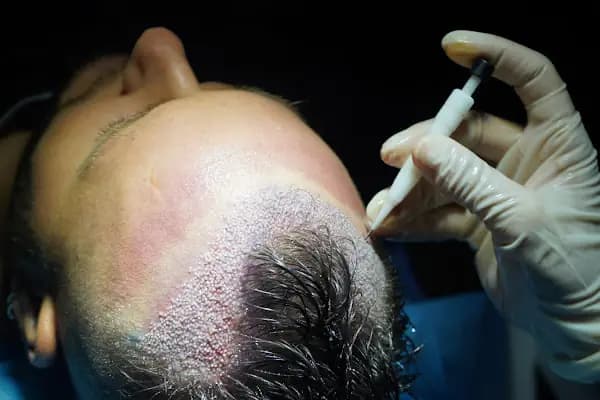 ESTHETICANA - Exclusive Hair Transplant in Turkey - Saç Transplantasyonu Kliniği - İstanbul Zeytinburnu