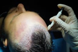 ESTHETICANA - Exclusive Hair Transplant in Turkey
