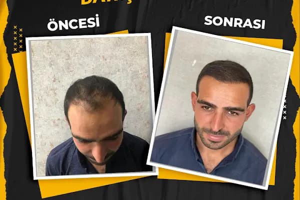 FBK Danışmanlık - Saç Yenileme Hizmeti - Şanlıurfa Eyyübiye