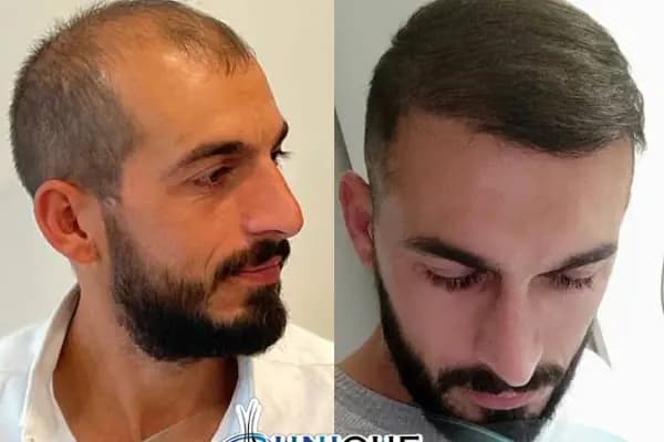 Unique Hair Transplant - Saç Yenileme Hizmeti - İstanbul Üsküdar