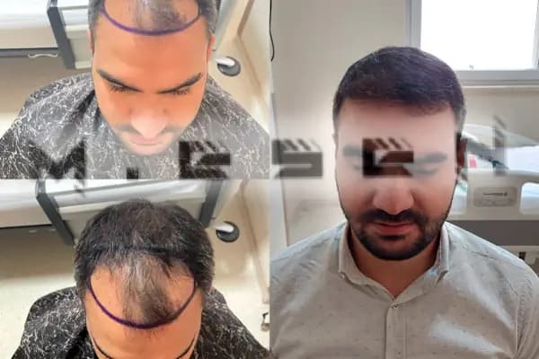 Mesen Saç Ekimi - Saç Transplantasyonu Kliniği - Ankara Beypazarı