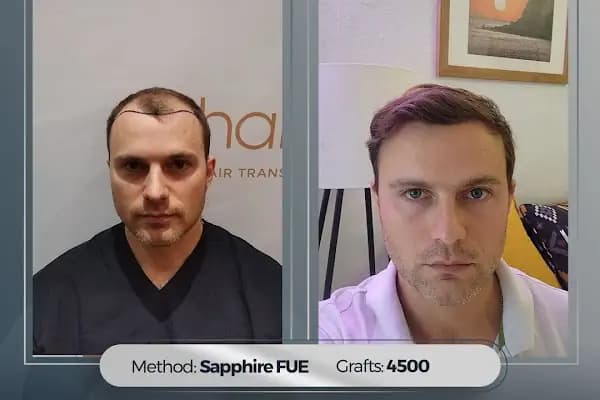 Hairpol | Hair Transplant Clinic (Saç Ekimi Kliniği) - Saç Transplantasyonu Kliniği - İstanbul Ataşehir