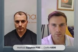 Hairpol | Hair Transplant Clinic (Saç Ekimi Kliniği)