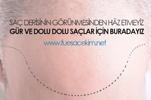 Gaziantep Saç Ekim&amp;Protez - Fue Estetik - Estetik Cerrah - Gaziantep Nizip