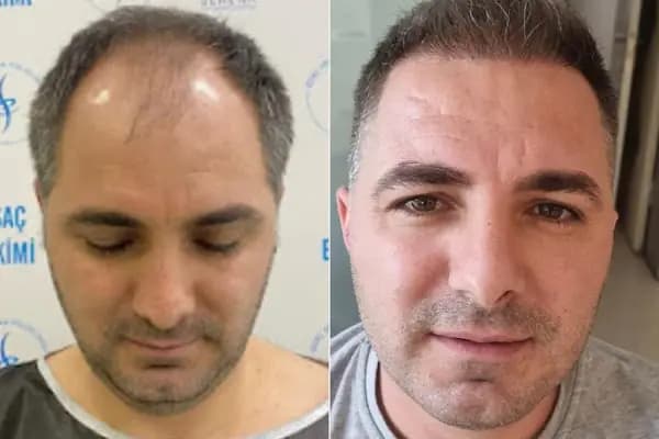 Özel Serena Polikliniği | Lazer Epilasyon | Buz Lazer | Botoks | Saç Ekimi | Dudak Dolgusu | Gençlik Aşısı - Epilasyon Hizmetleri - İzmir Bayraklı
