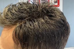 Protez Saç Ankara (Hairlife)