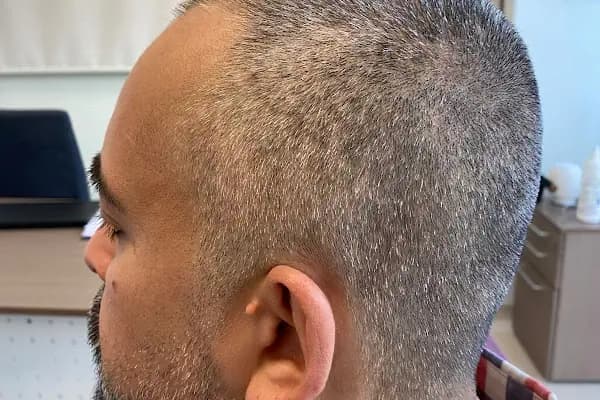 Bilyana Hair Clinic Saç Ekim Merkezi - Saç Transplantasyonu Kliniği - Antalya Alanya