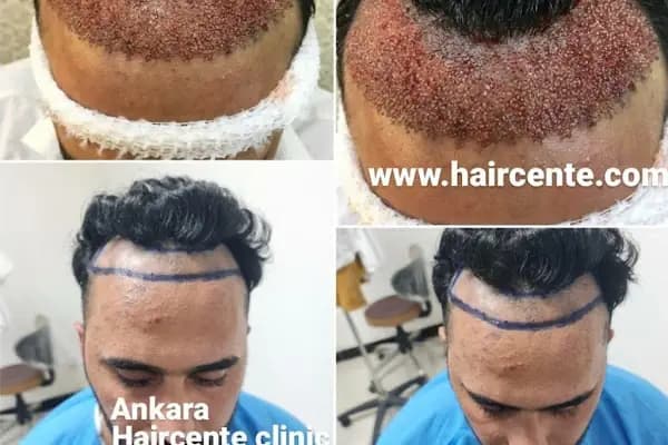 Ankara Saç Ekim Merkezi (Haircente Clinic) - Saç Transplantasyonu Kliniği - Ankara Çankaya