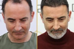 For Legend Hair Transplant