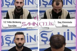 LifeHair Ankara | Saç Ekimi Ankara | Şahin Çelik | Ankara Saç Ekim Merkezi