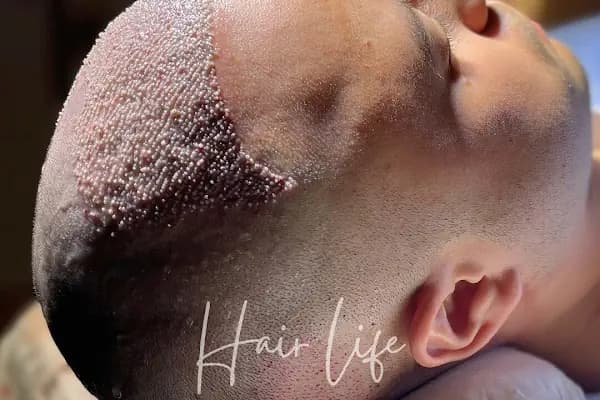 Hair Life Saç Ekim Merkezi - Saç Transplantasyonu Kliniği - İstanbul Kartal