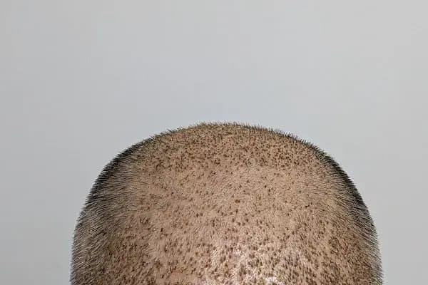 Double Hair Center | Saç Ekim Merkezi - Saç Yenileme Hizmeti - İstanbul Bahçelievler