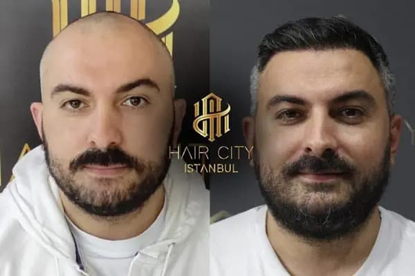 Hair City İstanbul Saç Ekimi - Saç Transplantasyonu Kliniği - İstanbul Kadıköy