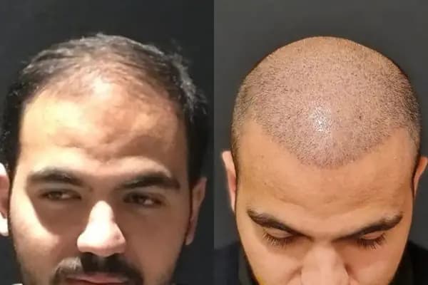 May Hair Center - Saç Transplantasyonu Kliniği - İstanbul Bakırköy