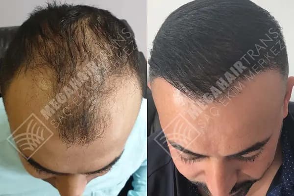 Mega Hair Trans Saç Ekim Merkezi İstanbul - Saç Transplantasyonu Kliniği - İstanbul Beşiktaş