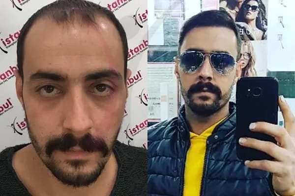 İstanbul Transplus Saç Ekim Merkezi KONYA - Saç Transplantasyonu Kliniği - Konya Selçuklu