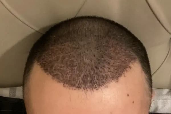 SE Hair Clinic | Hair Transplant Antalya - Saç Transplantasyonu Kliniği - Antalya Alanya