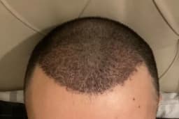 SE Hair Clinic | Hair Transplant Antalya