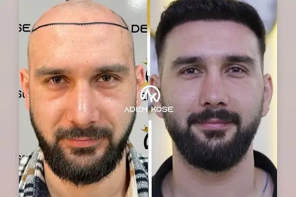Adem Köse - Hair Transplant Turkey - Saç Transplantasyonu Kliniği - İstanbul Küçükçekmece
