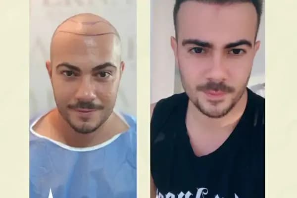 Erna Hair Clinic İzmir Saç Ekim Merkezi - Saç Transplantasyonu Kliniği - İzmir Konak