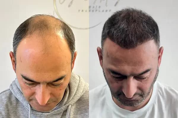Ozan Ablay Hair Transplant - Sağlık Merkezi - İzmir Balçova
