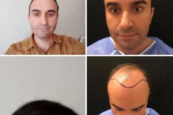 Emphair Hair Transplantation Premium Istanbul Clinic - Saç Ekimi - EMPCLINICS - Saç Transplantasyonu Kliniği - İstanbul Ataşehir