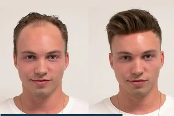 Alanya hairtransplant and prosthetic hair Center ( Alanya saç ekimi ve protez saç merkezi ) - Saç Transplantasyonu Kliniği - İzmir Balçova