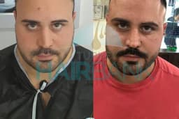 Turkey Hair Bank