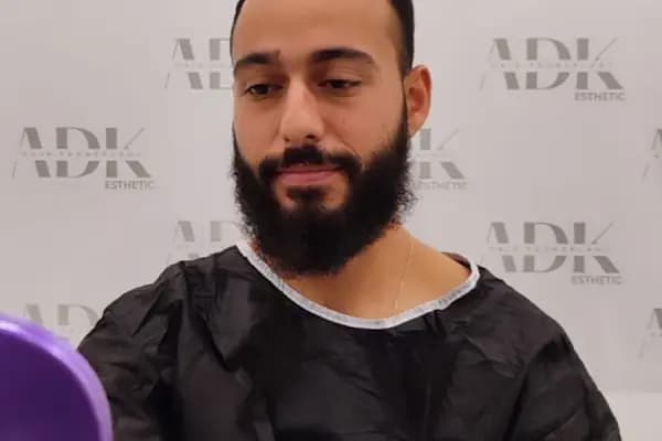 Adk Hair Transplant - Saç Ekimi - Saç Transplantasyonu Kliniği - İstanbul Ataşehir