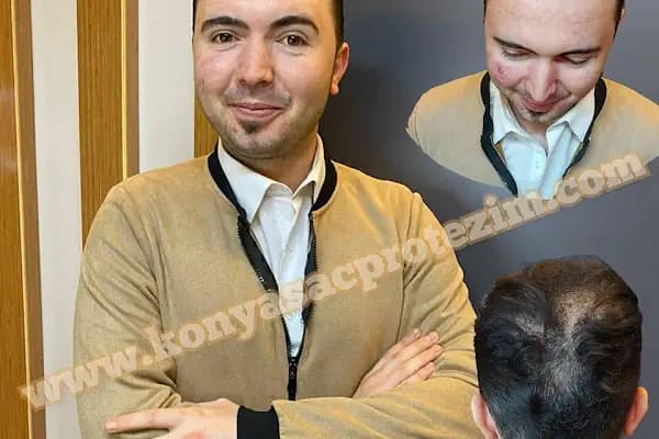 Nafiz Keskin Protez Saç Kliniği - Güzellik Salonu - Konya Selçuklu